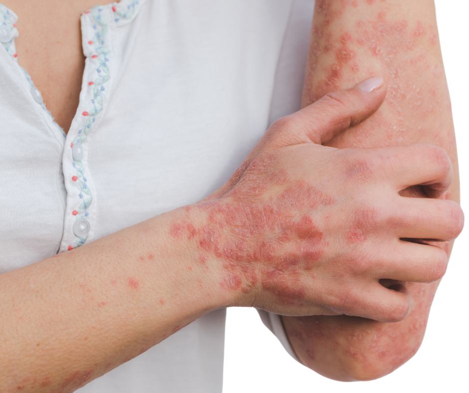 psoriasis