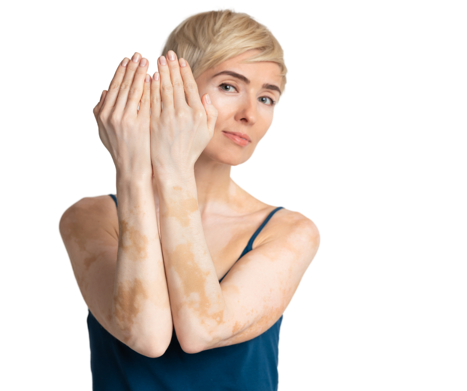 vitiligo